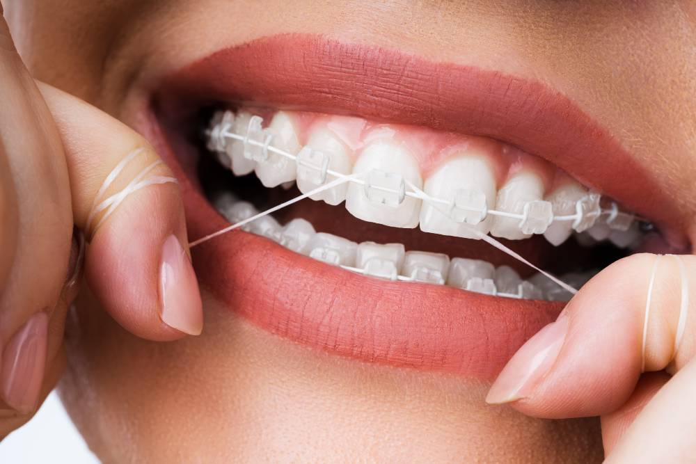 Even though flossing with braces can be challenging, learn why flossing is so important for your dental health.