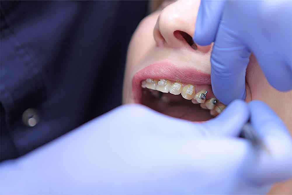 braces with crowns