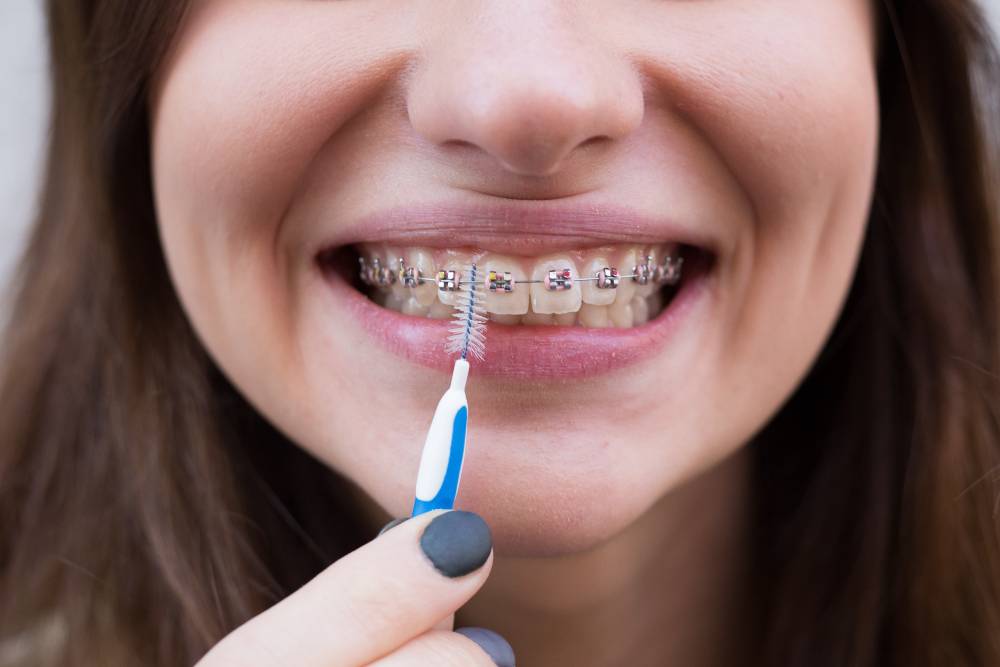teeth clean with braces