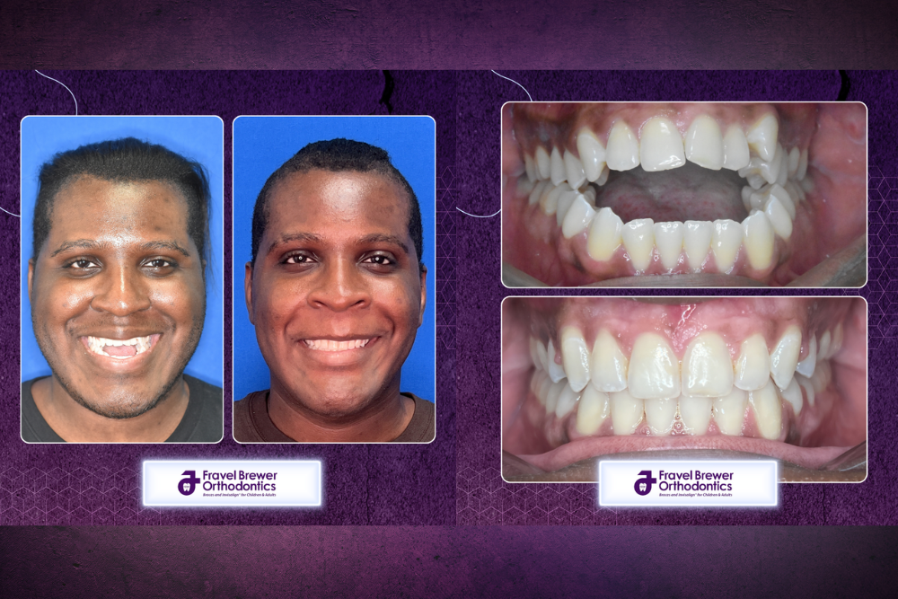 Braces in Orlando Corrective Jaw Surgery - Jaylan